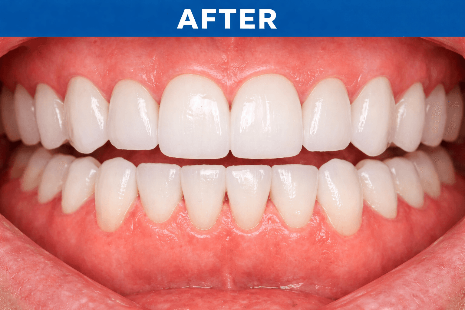 Orthodontic Alignment after