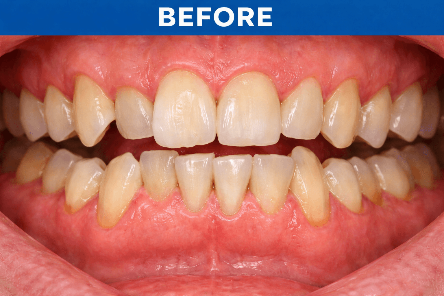 Orthodontic Alignment before