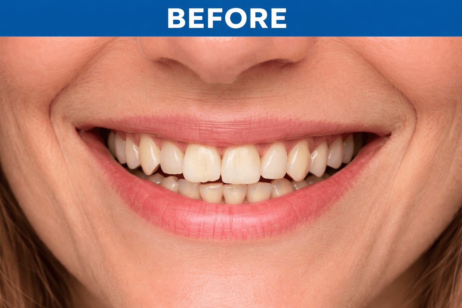 Smile Makeover before