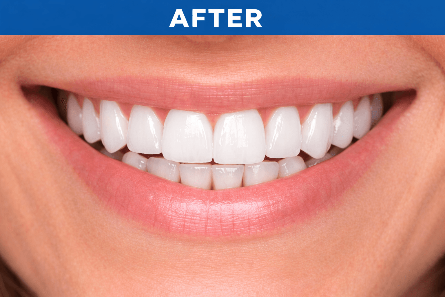 Teeth Whitening after