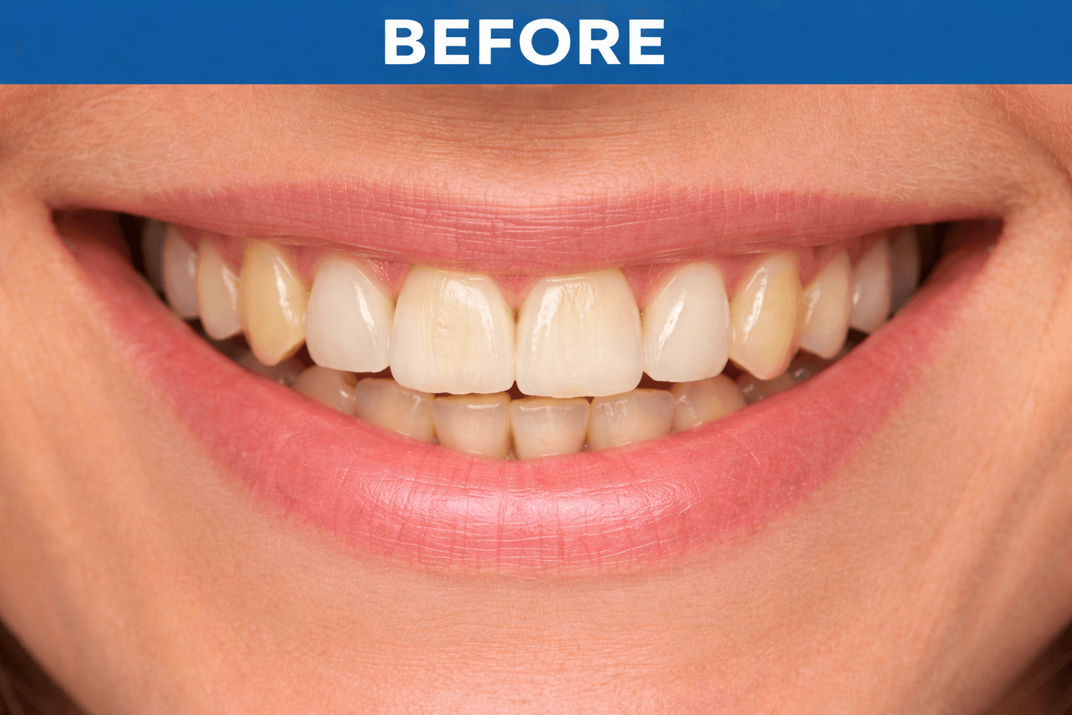 Teeth Whitening before