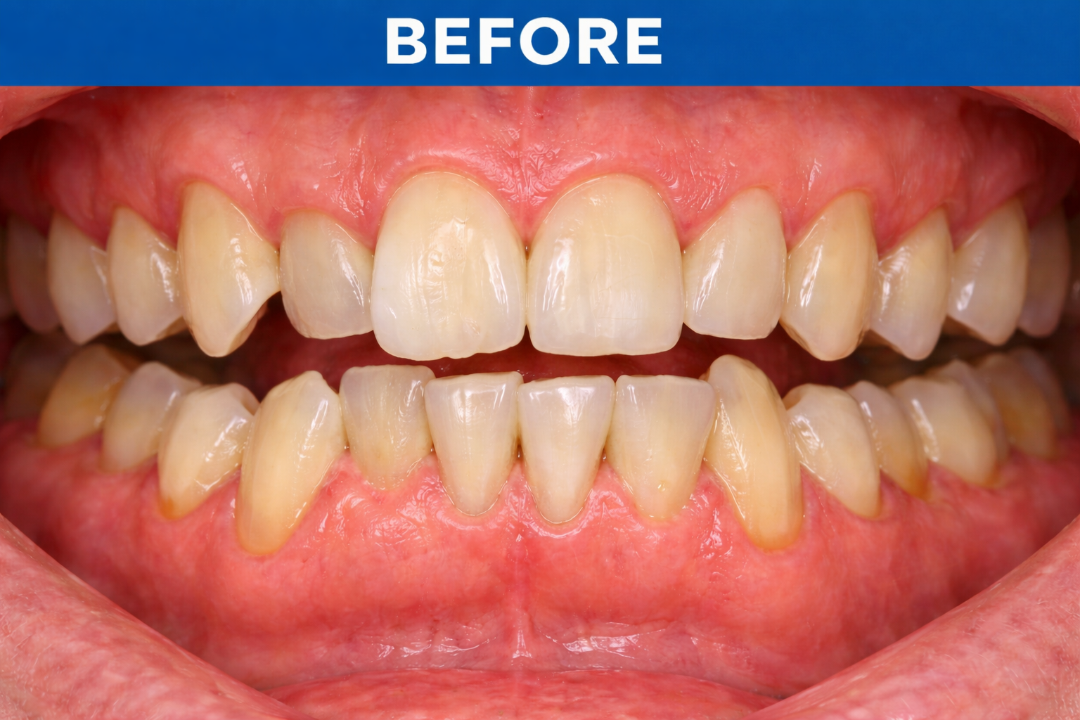 Orthodontic Alignment before