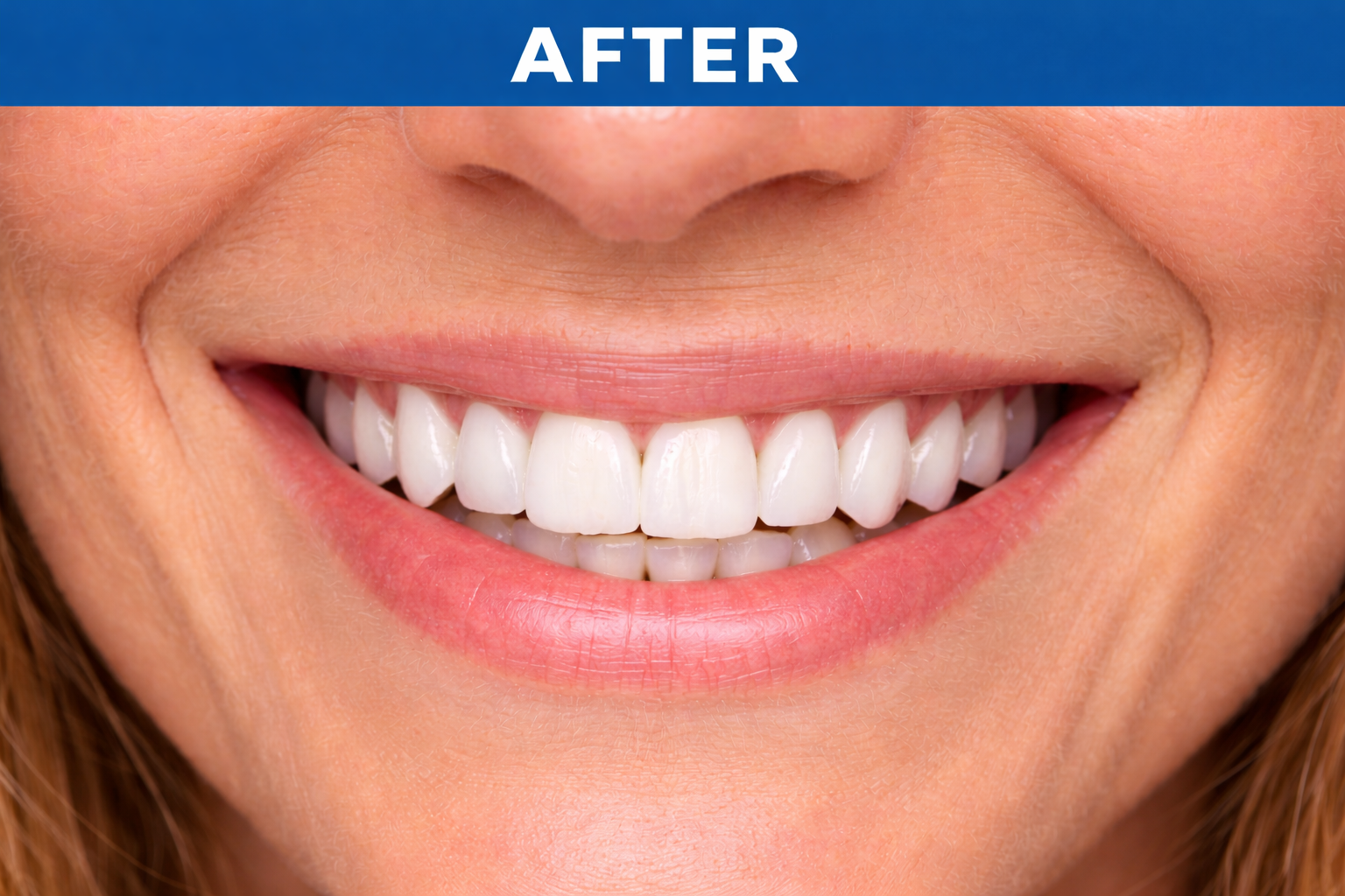 Smile Makeover after