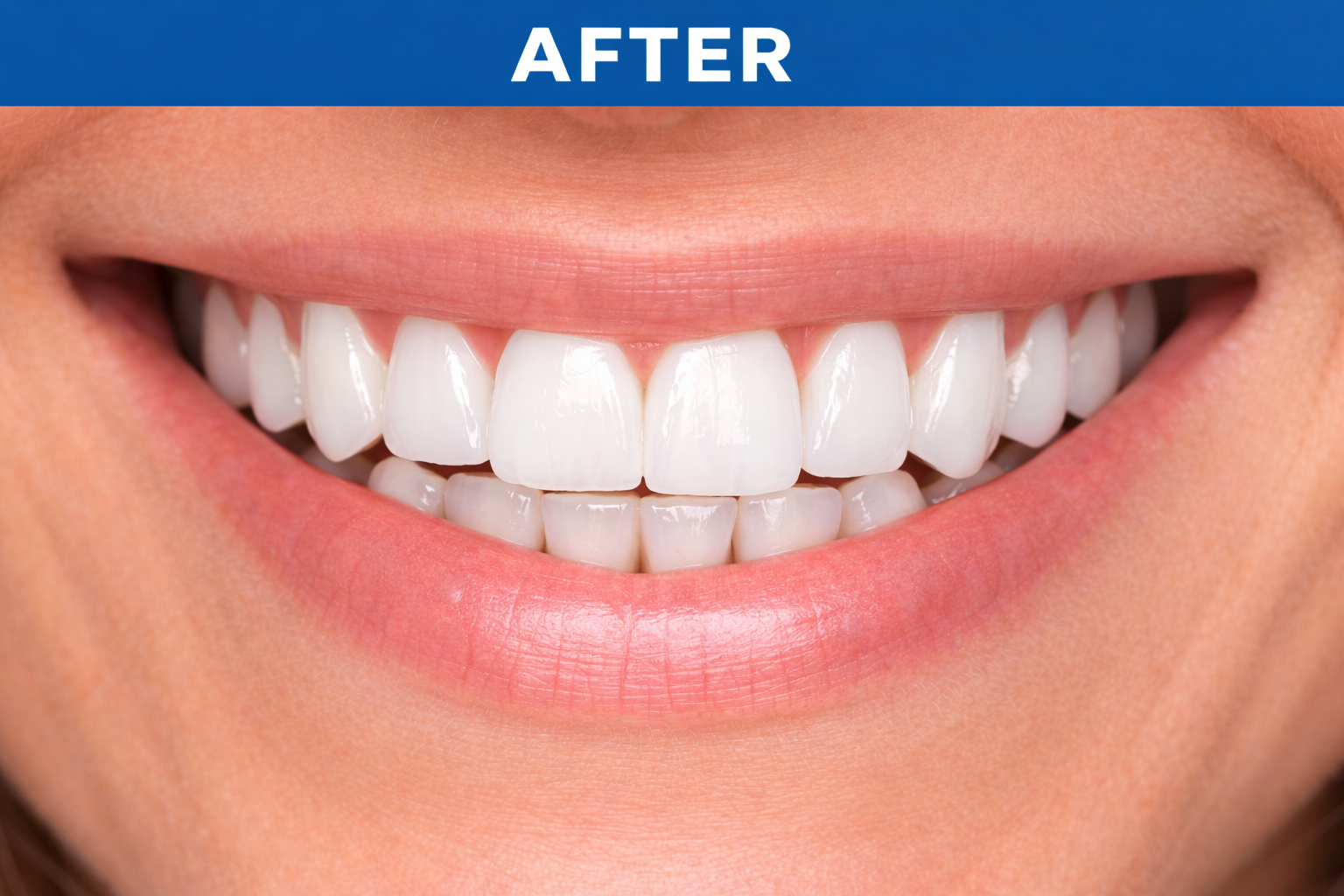 Teeth Whitening after